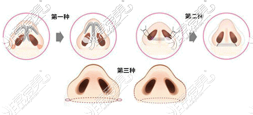 变瘦可以缩小鼻翼吗?别在花冤枉钱了带你看真行有效方式