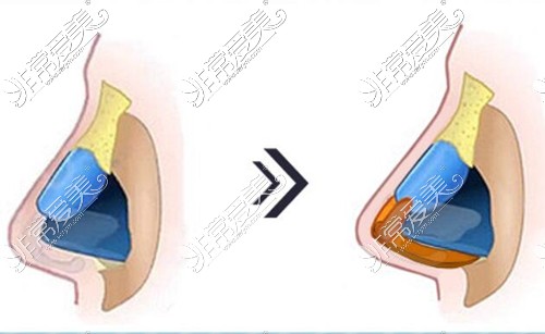 半肋骨鼻能维持几年，一看医生技术，二看搭配啥隆鼻假体