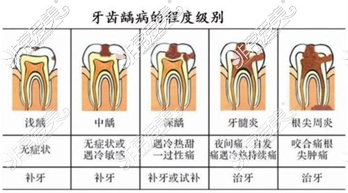 龋齿的发展及症状、治疗方式