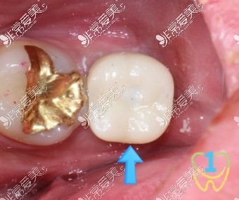 26岁一口烂牙咀嚼困难