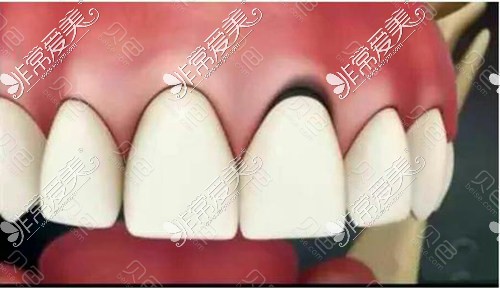 全瓷牙修补可避免牙龈发黑情况