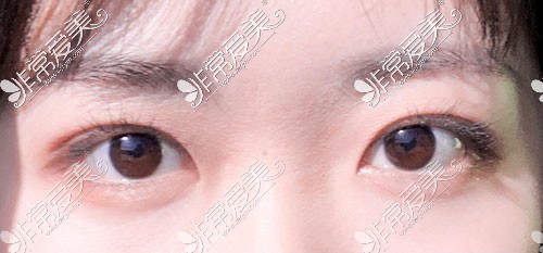 韩国yellow双眼皮术后30天