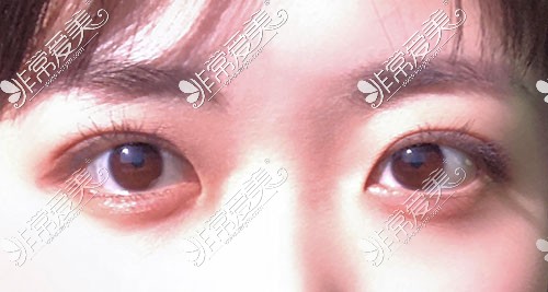 韩国yellow双眼皮术后恢复照