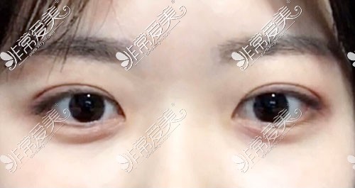 韩国yellow双眼皮术后60天