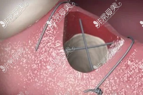 种植牙伤口模拟图