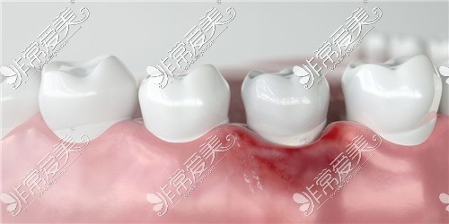 常见的牙龈红肿