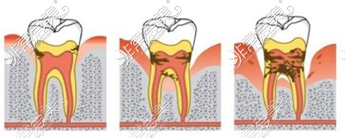 牙齿细菌侵害造成牙龈牙槽骨萎缩