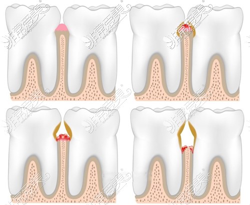 牙龈萎缩发展的几个阶段