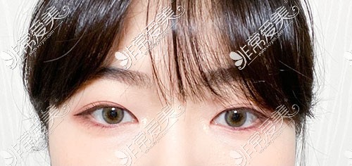 韩国yellow双眼皮手术