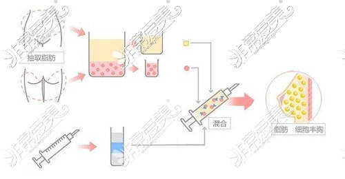 贵阳自体脂肪丰胸医生