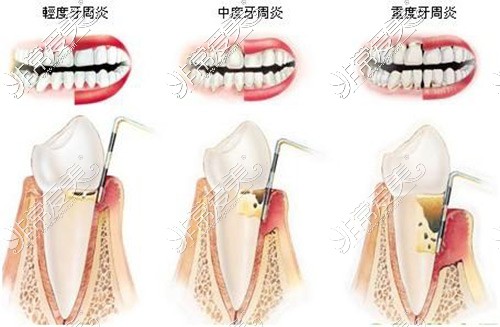 我才28岁牙齿全部脱落,不知原因只想问活动牙还是固定牙好