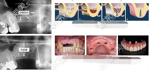种植牙流程示意图