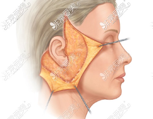 面部拉皮剥离范围