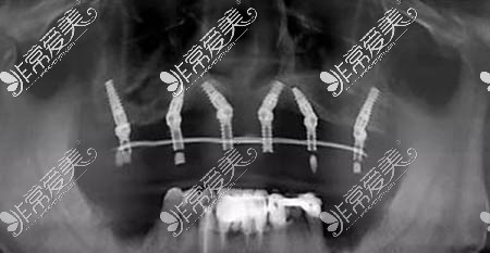 半口种植牙术后CT图片拍摄
