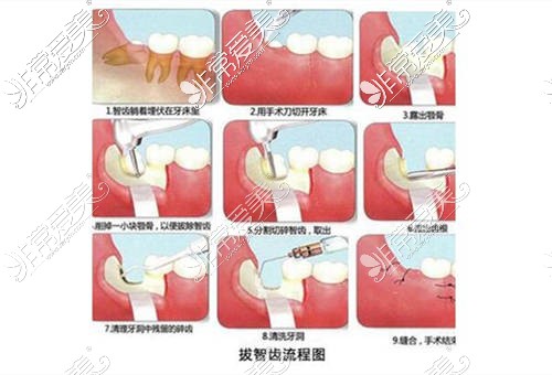 智齒拔出的過程