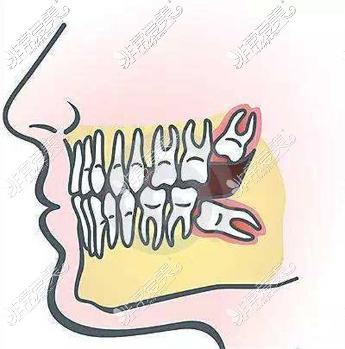 智齿在口腔的分布