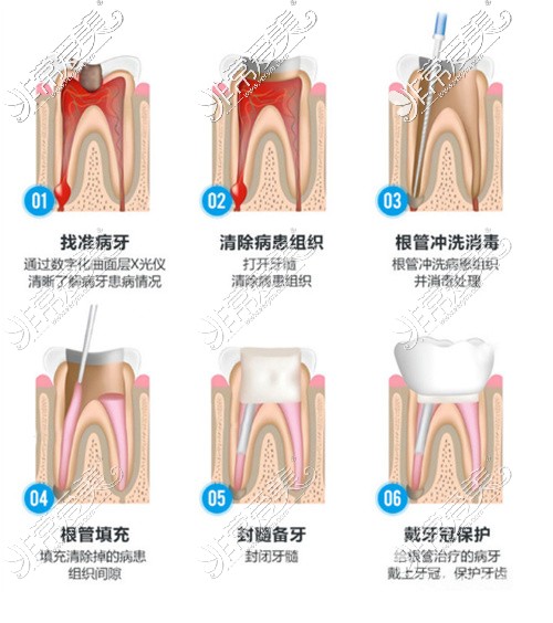 牙齿根管治疗图片步骤图片