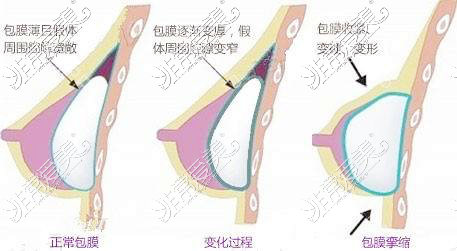 假体隆胸后一摸就很假？1招教你选对隆胸方式保证真实手感