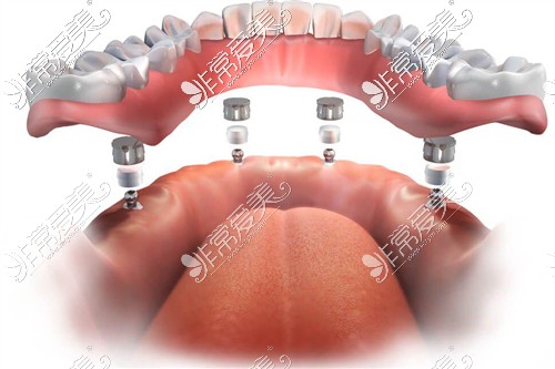 allon4种植牙3D立体示意图