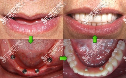 allon4种植牙术前术后对比