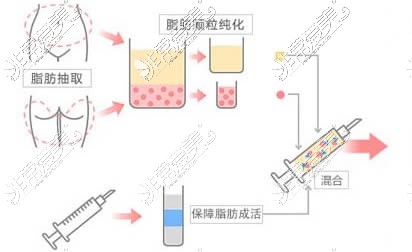 自体脂肪隆胸流程图展示