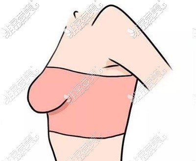 胸部下垂卡通图展示照片