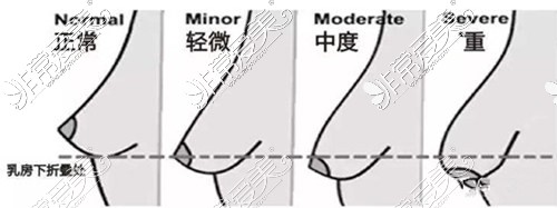 小姑娘二十二岁胸下垂是什么导致的？应该如何矫正修复？