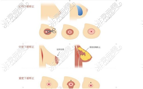 双环乳房悬吊手术方式图片