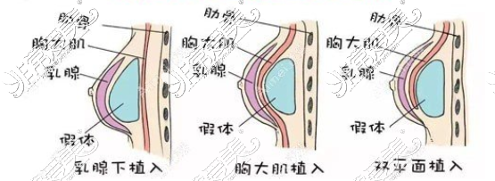 假体隆胸