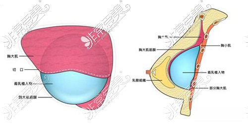 双平面隆胸位置