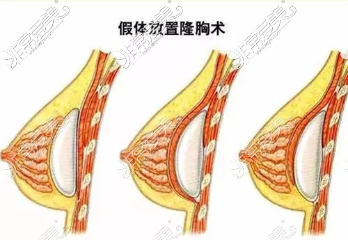 三种假体放置隆胸术