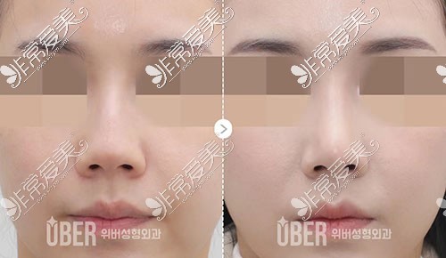 韩国uber整形隆鼻对比照片