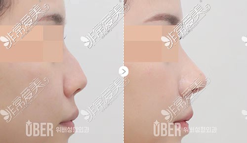 韩国uber整形做鼻子侧面照片