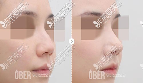 韩国uber整形隆鼻图片