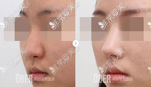 韩国uber整形隆鼻照片