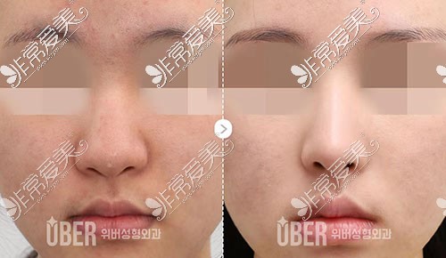 韩国uber整形隆鼻对比照片
