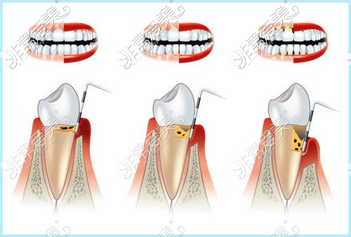 牙周炎示意图