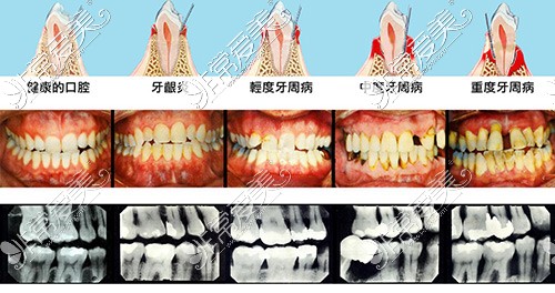 牙周炎示意圖