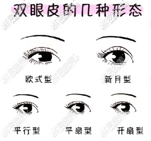 双眼皮的常见形态