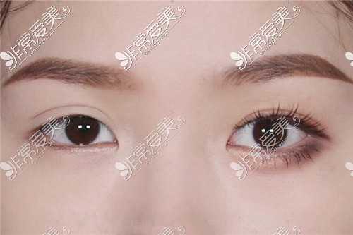 单只双眼皮修复导致双眼皮不对称