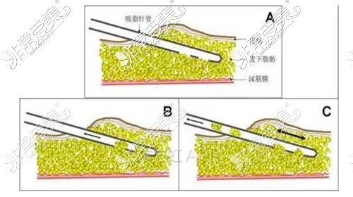 腰腹吸脂20天感觉就和没抽一样，多长时间能看到成效？