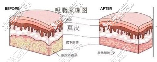 吸脂原理