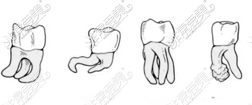 智齿牙体畸形