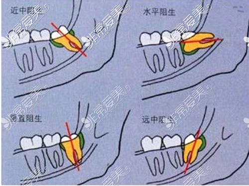 智齿的分类