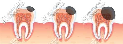 牙齿龋坏面积大小