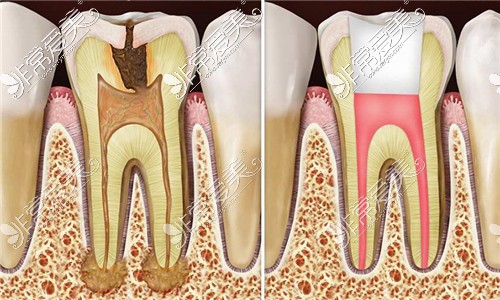 根管治疗前后对比