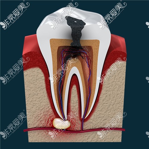 牙齿龋坏根尖部位炎症
