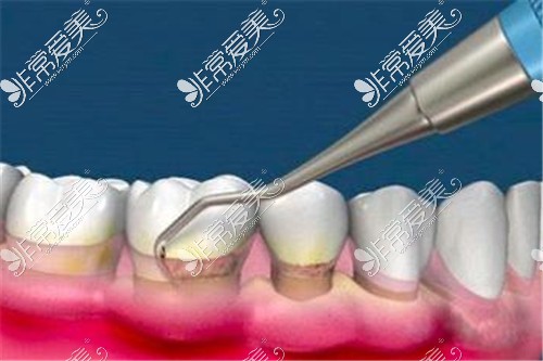 牙周炎刮治示意图