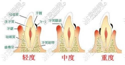 牙周炎轻度中度重度示意图