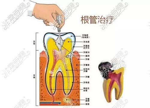 根管治疗就是骗局?是谣言还是真的这里告诉你